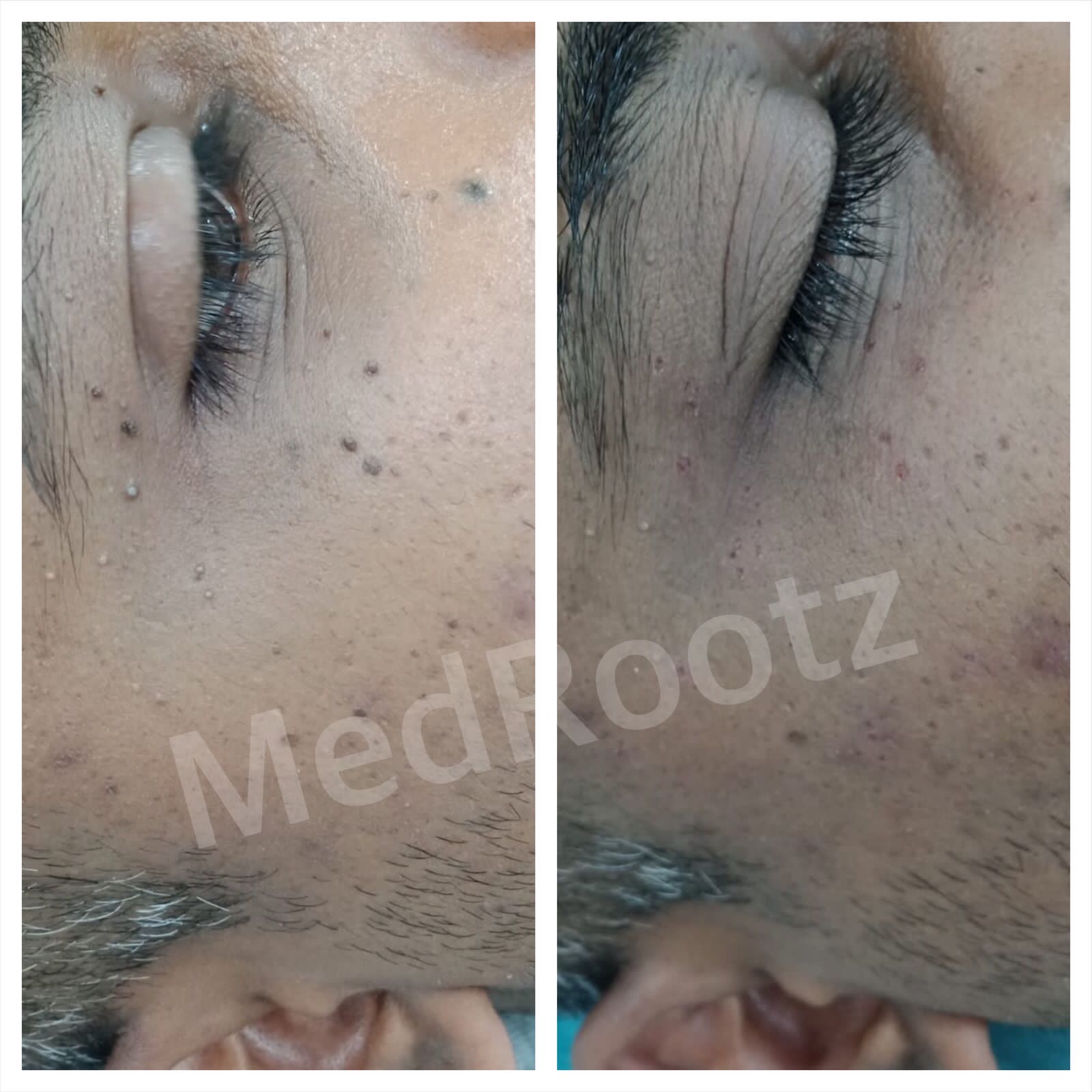 Best hair transplant doctor in delhi